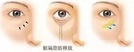 眼袋有多深你就有多老，祛眼袋一定要趁早！