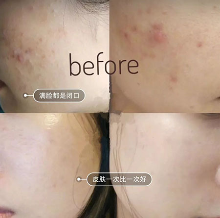 堪稱(chēng)“換臉”的神奇煥膚術(shù)，你get了嗎？