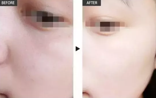 皮膚粗大還有救嗎？VN智能光電美膚讓你的肌膚不在“孔”慌