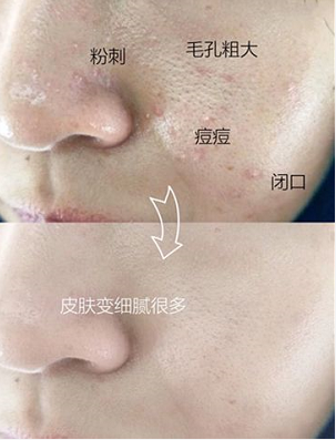 被粉刺、黑頭、毛孔、角質(zhì)糾纏？千萬別忽視深層清潔！