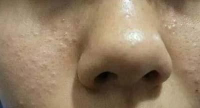 皮膚吸收不暢、粉刺痘痘不斷，是時候做下深層清潔了
