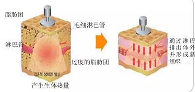 高周頻溶脂塑身