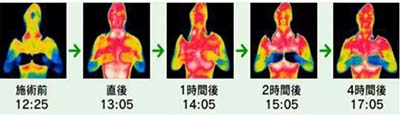 一次減3~6公分，塑形就選高周頻溶脂瘦身管理