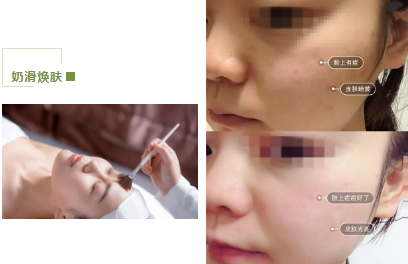去暗黃、除色斑，VN美白管理讓你年輕十歲！