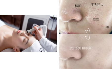 如何去黑頭？為什么要定期做去黑頭管理？VN給你好的答案