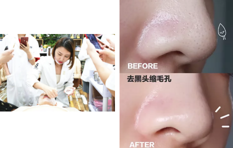 如何去黑頭？為什么要定期做去黑頭管理？VN給你好的答案