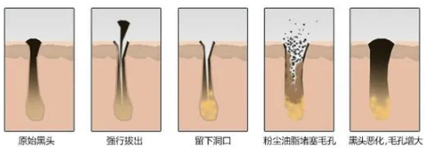 如何去黑頭？為什么要定期做去黑頭管理？VN給你好的答案